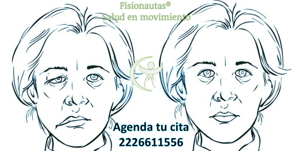 paralisis facial