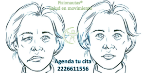 paralisis facial