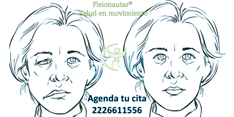 paralisis facial